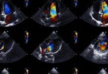 GE – ウィズコロナに最適化する「AI搭載ポイントオブケア超音波」(POCUS)