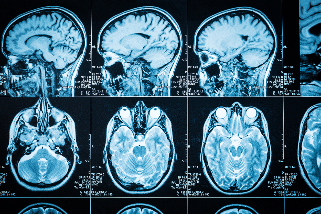脳腫瘍の悪性度をMRI検査画像からAIで予測 – 京大 iCeMs | 医療とAIの 