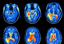 fMRI画像から軽度認知障害を超高精度に分類