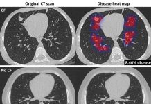 Thirona – 嚢胞性線維症のAIソフトウェアを公表