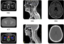GE Healthcare – MRIから合成CT画像を生成するAIソリューション